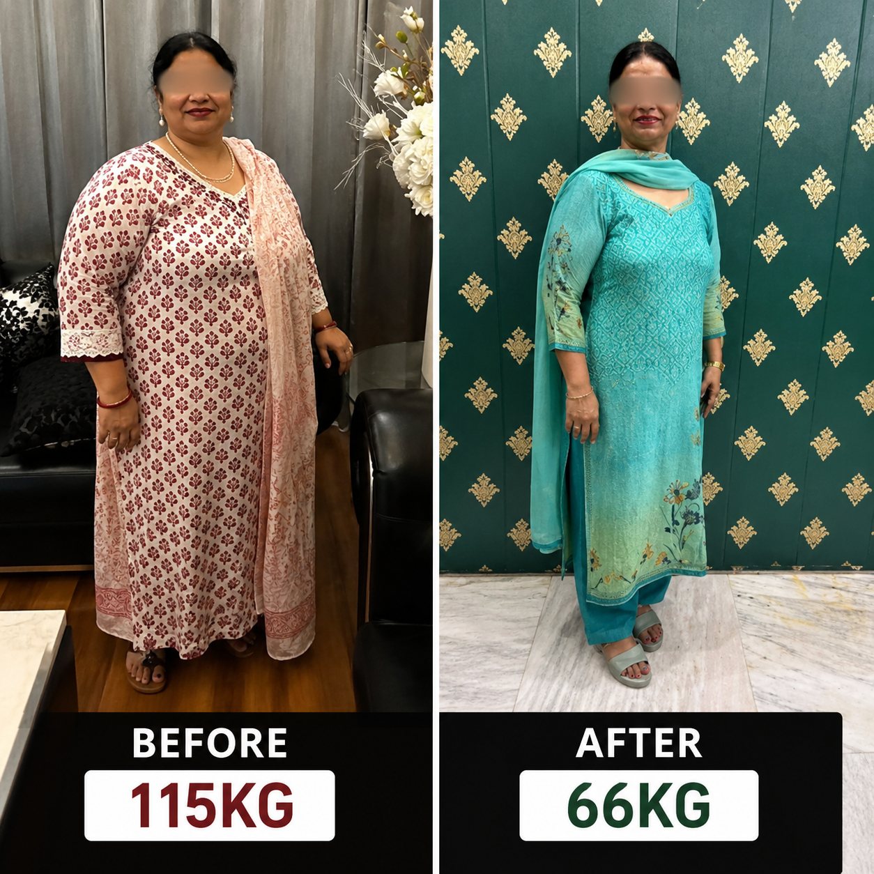 Before and after bariatric surgery - patient transformation