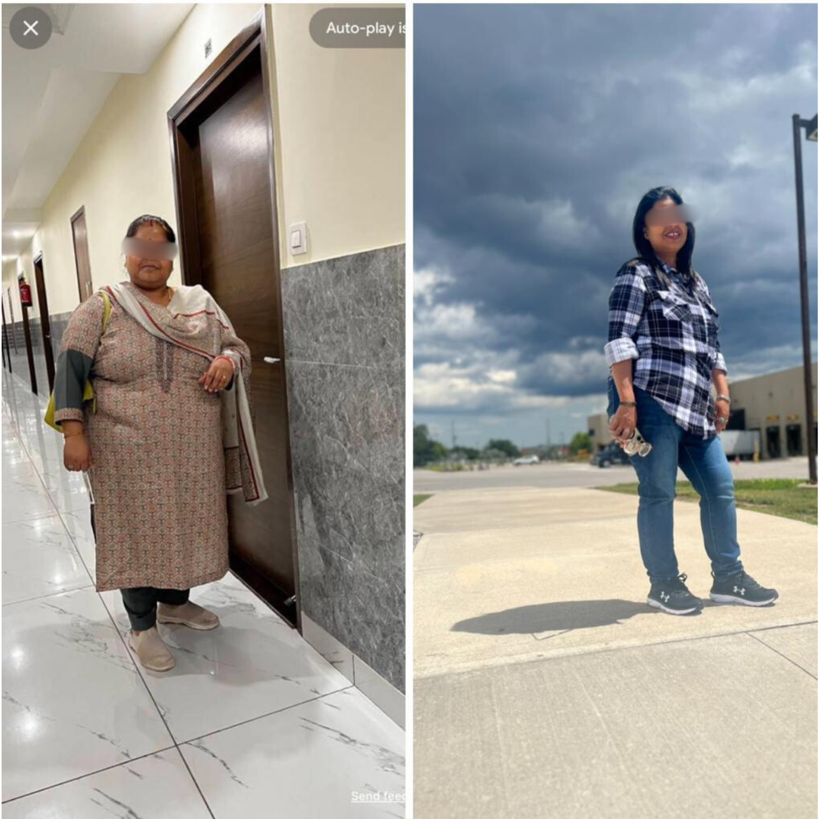 Patient lost 49 kg after weight loss surgery — 115 kg to 66 kg