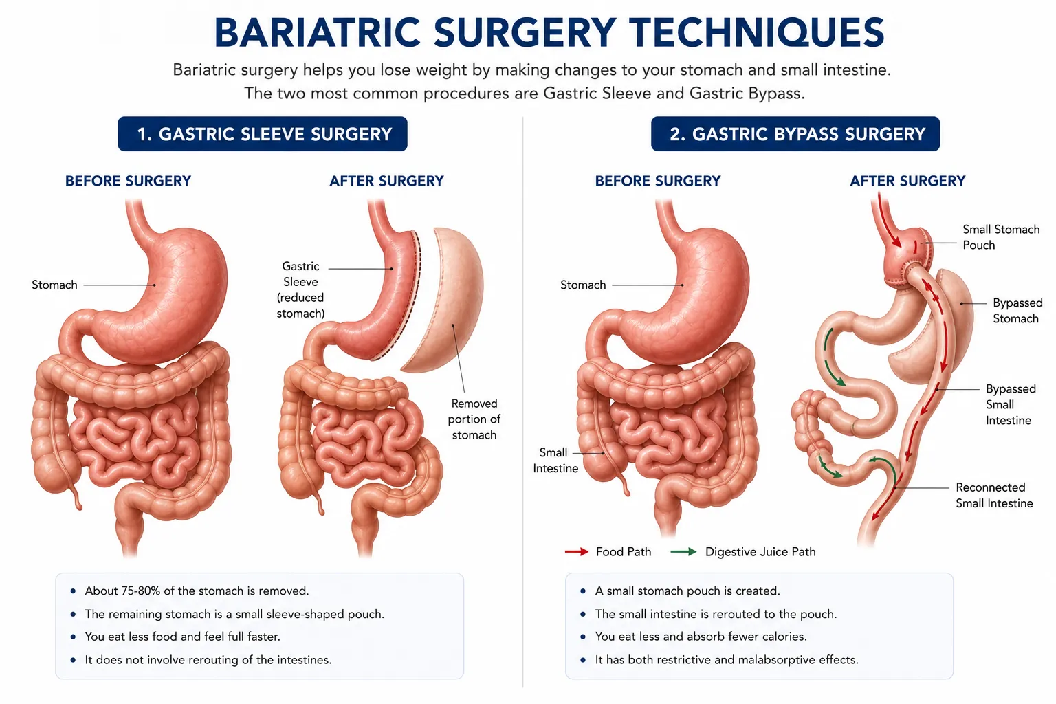 Medical illustration showing how bariatric surgery changes stomach size for weight loss