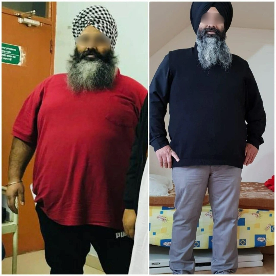 Before and after weight loss surgery