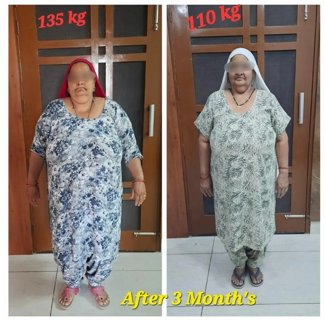 Before and after bariatric surgery at Meyash Hospital