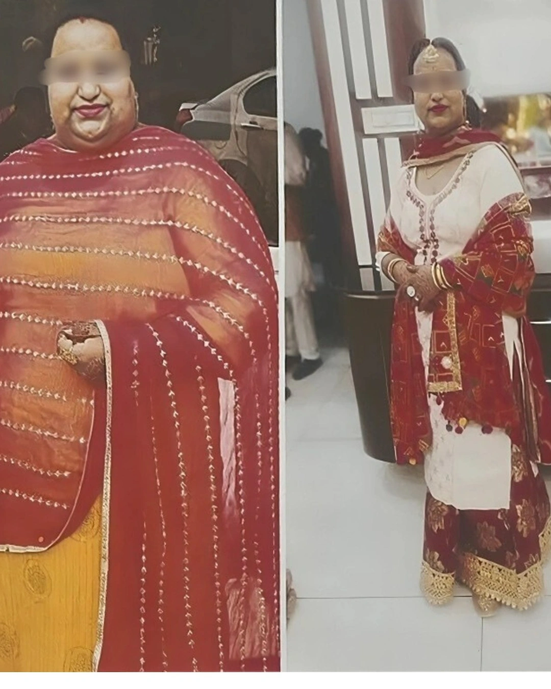 Before and after weight loss surgery - patient transformation