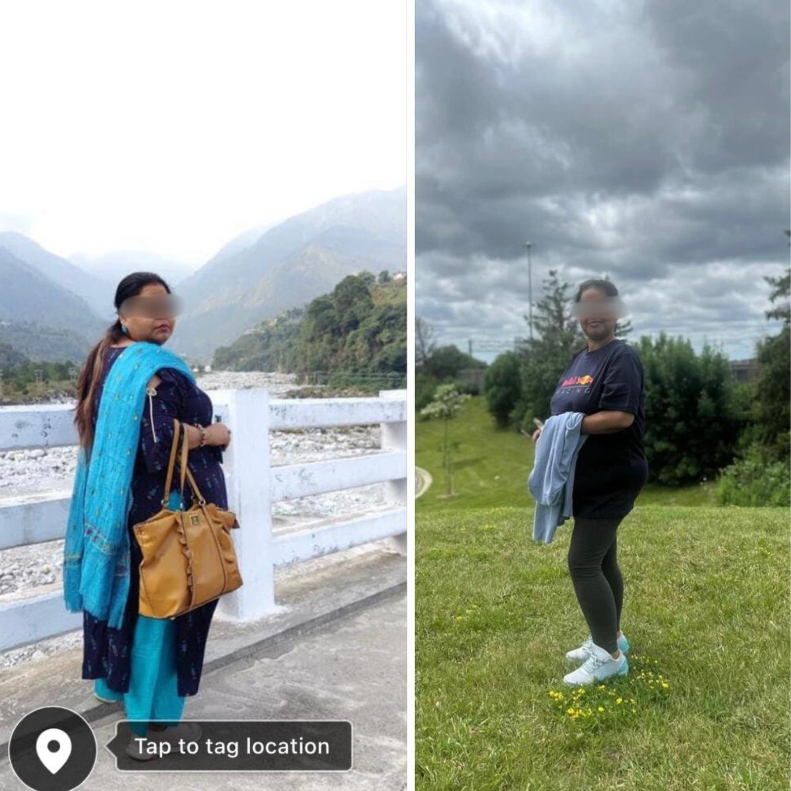 Before and after weight loss surgery